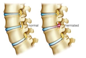herniated-disc-relief-in-Tampa-300x204