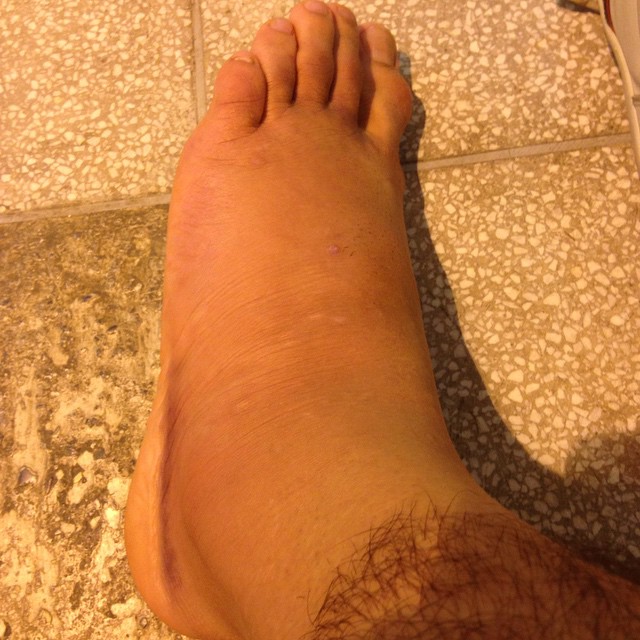 faria ankle