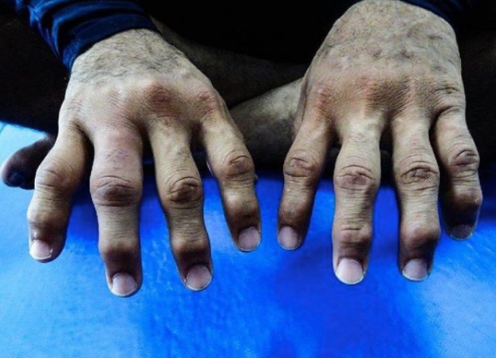 How To Decrease Knuckle, Finger & Joint Pain in Jiu-Jitsu
