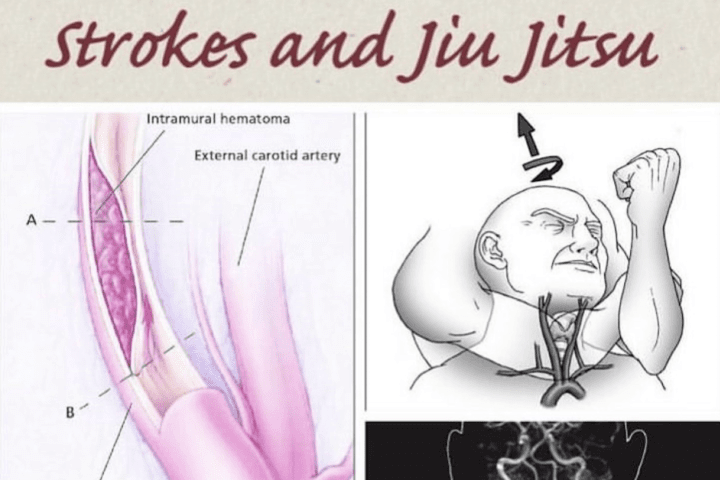 Vascular Neck Injuries and Strokes in BJJ: Recognizing the Warning Signs