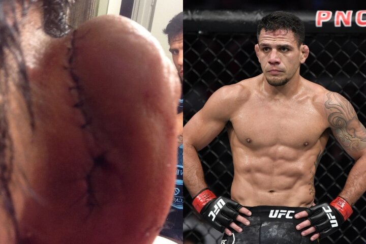 Rafael Dos Anjos Reveals That His Ear Almost Fell Off Before Fight With Khabib